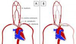 Subclavian steal.jpg