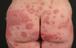 psoriasis-vulgaris-hips-e1472814561484.jpg