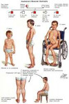 anatomy-and-physiology-of-duchenne-muscular-dystrophy-13.jpg