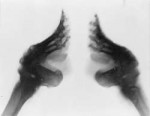 1280px-Boundfeet(X-ray).jpg