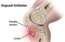 Osgood-Schlatter-disease1