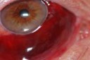 Subconjunctival-Hemmorhage-3.jpg