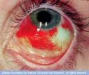 ds00867im03228r7subconjunctivalhemorrhagethujpg.ashx