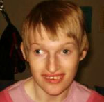 Angelman Syndrome-5.jpg