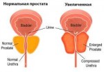 giperplaziya-predstatelnoy-zhelezyi.jpg