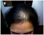 diseases-that-cause-alopecia5.jpeg