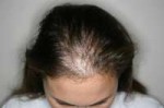 hair-loss-in-women-Small.jpg