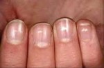 When-you-have-these-white-spots-or-lines-on-your-nails—its-[...].jpg