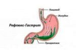 refljuks-gastrit604x403.jpg