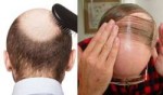 baldness.jpg