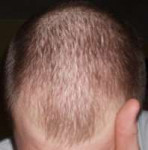 diffuse-patterned-alopecia-297x300.jpg