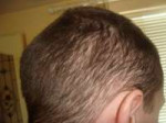 diffuse-unpatterned-alopecia.jpg