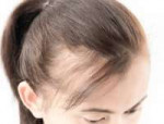 postpartum-alopecia-500x383.jpg