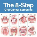 oral-cancer-screening-picture.jpg