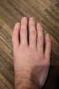 handsyndrome02.jpg