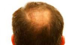 alopeciya-photo1-56.jpeg