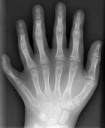 Polydactyly01LhandAP.jpg